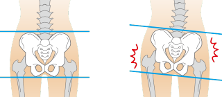 骨盤が歪んでない場合と歪んでいる場合の対比